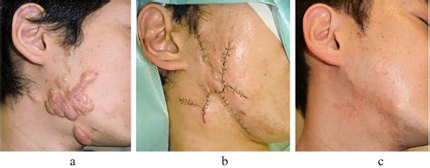 Surgical excision and postoperative radiotherapy for keloids - Rei ...