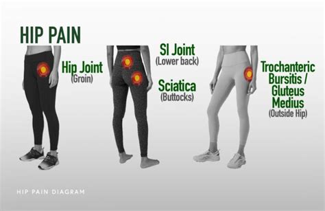 Non-Surgical Hip Pain Treatment Chicago, IL | Dr. Jorge Chahla