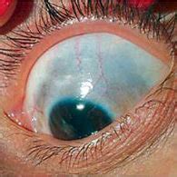 Brownish mottled macules on the iris and sclera. | Download Scientific Diagram