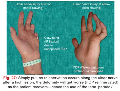 Ulnar Nerve Lesions Causes Diagnosis