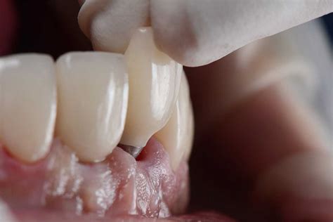 Fix A Failed Dental Implant Or Implant Crown – Gordon Dental