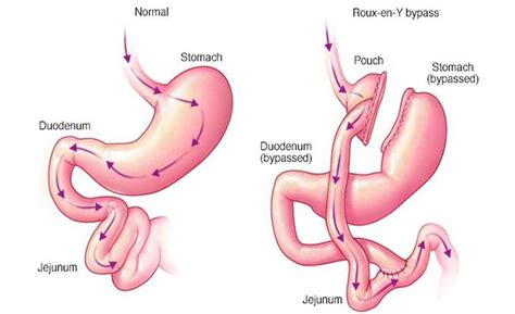 Roux en Y Laparoscopic Gastric Bypass - New Life Bariatric