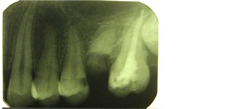 Maxillary Second Molar with Single Root and Single Canal—Case Report