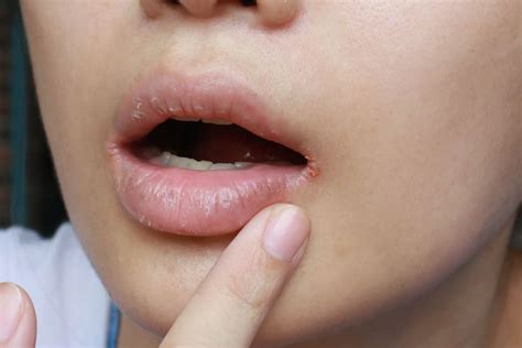 Yeast Infection on Face: Why It Happens and How to Treat It