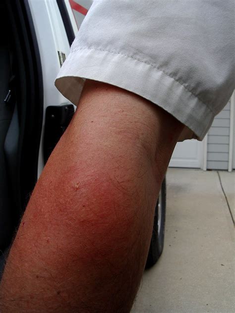 Wasp Sting Reaction | 2 days after being stung by a paper wa… | Flickr