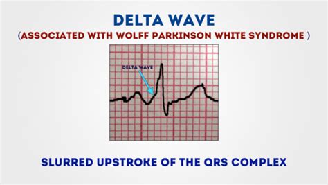 How to Read an ECG | ECG Interpretation | EKG | Geeky Medics