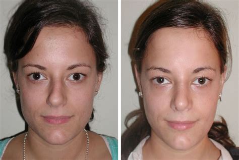 Septoplasty Before And After Pictures - Haha Wallpaper