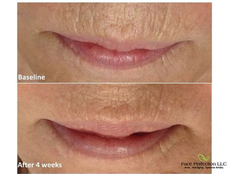 Micro Needling Before & Afters | Microneedling, How to line lips, Health skin care