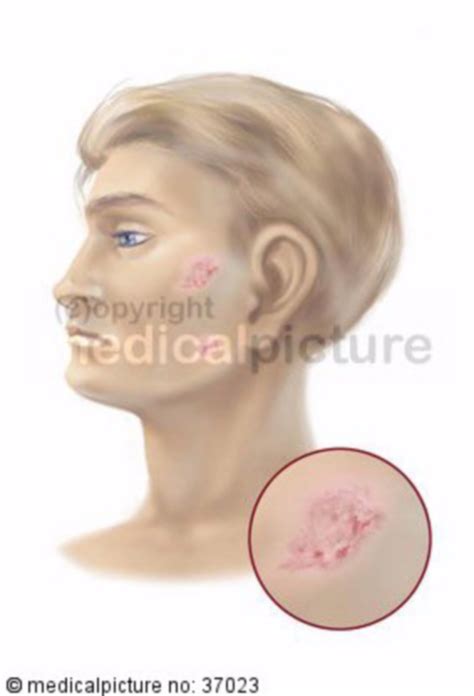 White skin cancer - Basal cell carcinoma - DocCheck