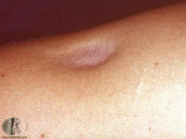 Dermatologic Manifestations of Localized Lipodystrophy: Background ...