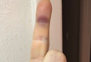 Sudden Purple Bruise on Underside of Index Finger » Scary Symptoms