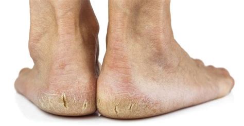 What Everybody Ought To Know…About Dry Cracked Heels: Beltsville Foot and Ankle Center: Podiatrists