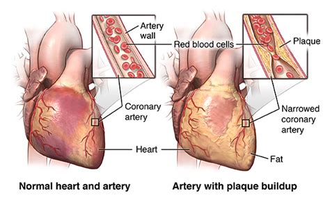 Coronary Artery Bypass Graft Surgery | Johns Hopkins Medicine