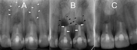 Cureus | Management of Symptomatic Horizontal Mid-root Fractures after Unsuccessful Orthograde ...