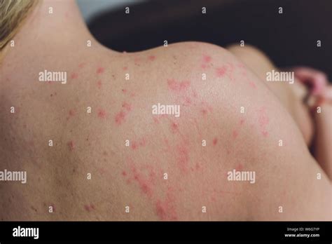 Close up Allergy rash, Around Back view of human with dermatitis ...