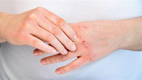 Atopic Dermatitis (Eczema): Causes, Symptoms, Treatments and Medications