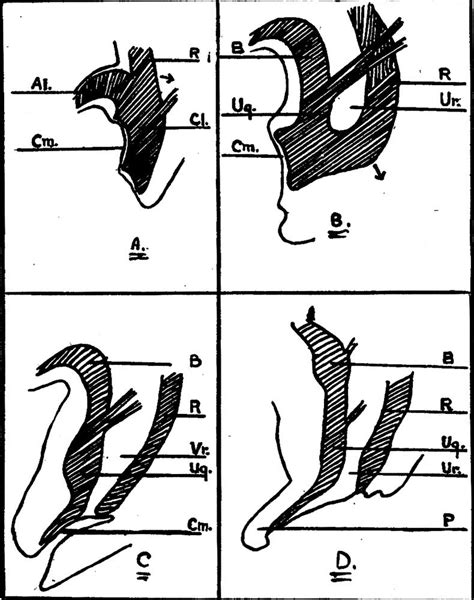 Paper - Congenital hernia into the umbilical cord - two cases, one ...