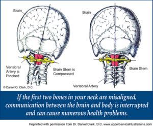 What is Upper Cervical? | Chiropractic Hendersonville NC