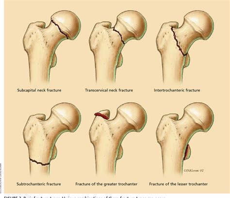 Figure 3 from Hip fractures in adults. | Semantic Scholar