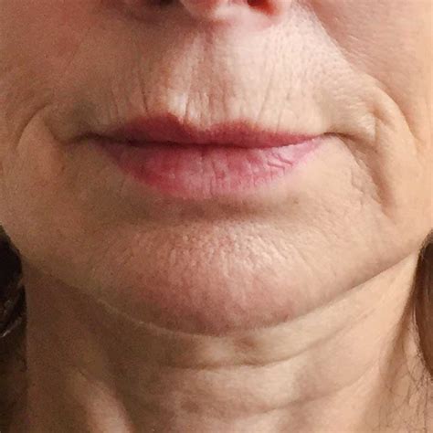 How Can I Get Rid Of Lines Above My Lips | Lipstutorial.org