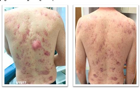 Figure 1 from Clinical Improvement of Severe Chronic Acne Conglobata. Case Report | Semantic Scholar