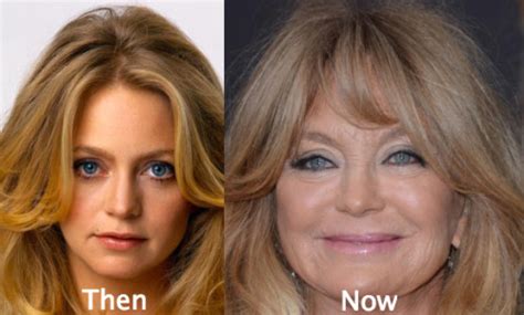 Goldie Hawn Plastic surgery before and after - Latest Plastic Surgery Gossip And News. Plastic ...