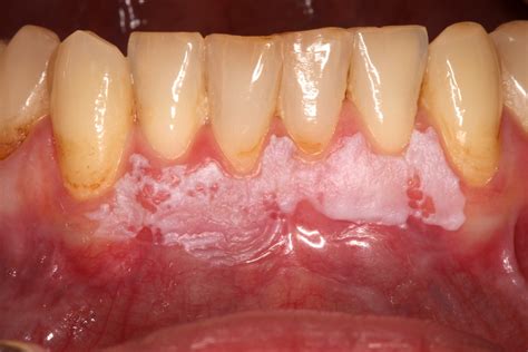 Proliferative Verrucous Leukoplakia