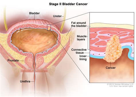 Stades du cancer de la vessie - Fmedic