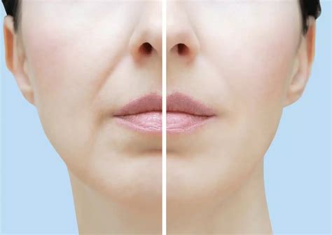 Using Juvederm to Treat Nasolabial Folds | Medica Depot