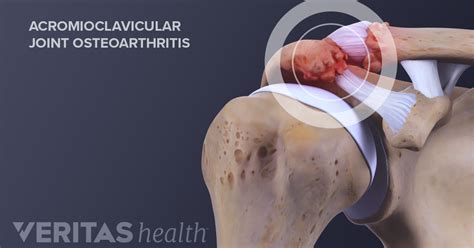 What is Acromioclavicular Arthritis (AC Joint Arthritis)? | Arthritis ...