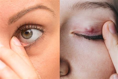 Chalazion vs Styes: What You Need To Know - K Health
