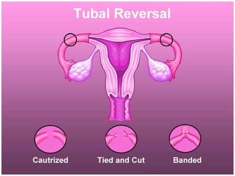 Tubal Ligation Reversal Procedure Description | MyMediTravel Knowledge