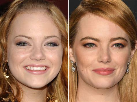 Emma Stone Before And After Weight Loss