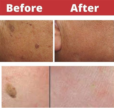 Buy The Seborrheic keratosis Removal Glycolic Acid Peel Solution, The specialised 70% Glycolic ...