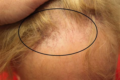 Frontal fibrosing alopecia causes, symptoms, diagnosis, treatment & prognosis