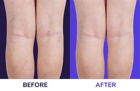 VARICOSE VEINS - Stamford Skin Centre