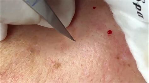 acne Blackheads Whiteheads Removal | Blackhead extraction | enilsa brown #blackheads - YouTube