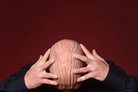 Powerful: These Photos Of Frowning Bald Men Are A Sobering Reminder ...