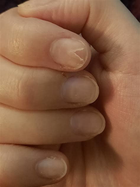 Split in nail : r/nailbiting