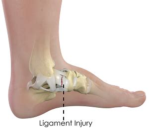 Ankle Ligament Injury - OrthoWashington