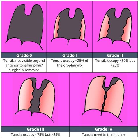 Tonsillitis - Clinical Features - Management - TeachMePaediatrics