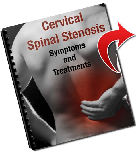 Cervical Foraminal Stenosis Treatments | PDF Guide