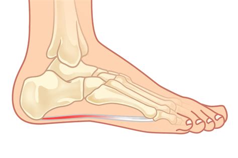 Plantar Fasciitis: The Complete Treatment Guide | Kintec