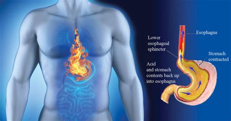 What Are The Symptoms of Acid Reflux? - Holistic Living Tips