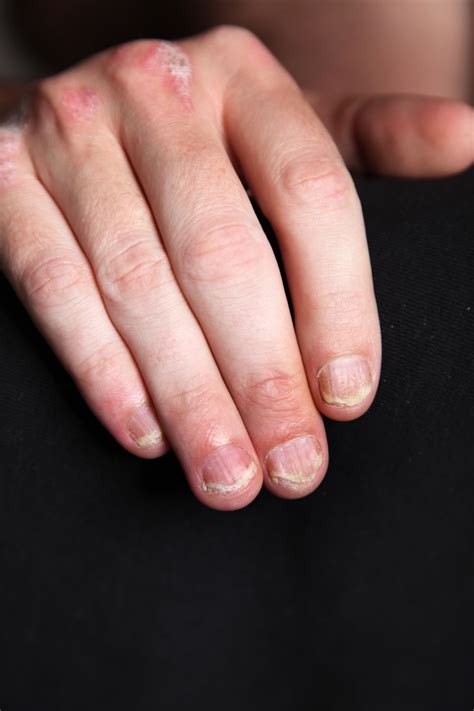 Nagelpsoriasis • Tüpfelnägel, Ölflecken & Krümelnägel | Nagelprobleme ...