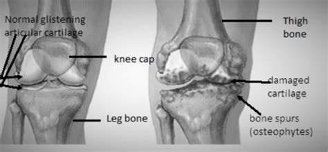 Knee Replacement - Ligaments and Joints Suregery