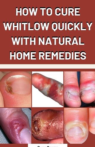 Whitlow Cure with Amazing Natural Home Remedies - 9jafoods