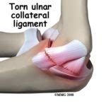 Ulnar Collateral Ligament Injuries – Howard J. Luks, MD