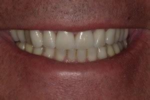 Dentist Before After Gallery, Family and Cosmetic Dentistry in 85716