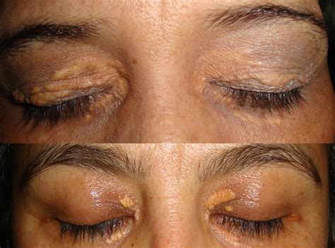 Xanthoma eye, tendinous, tuberous and disseminatum causes & treatment